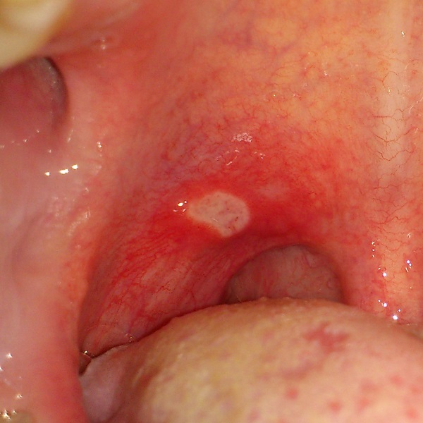 口腔潰瘍