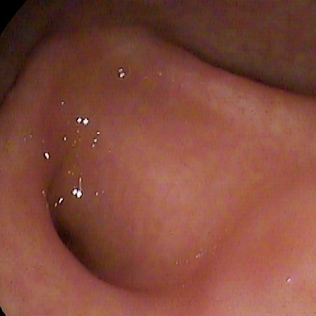 大腸鏡的英文怎麼說？