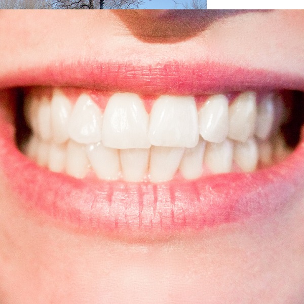 白牙齒 - 牙齒染色 - 中英物語 ChToEn